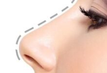 Rhinoplasty in Dubai