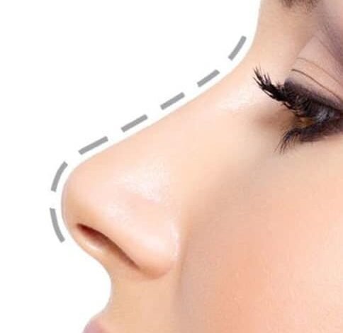 Rhinoplasty in Dubai